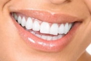 white-teeth-smile-200