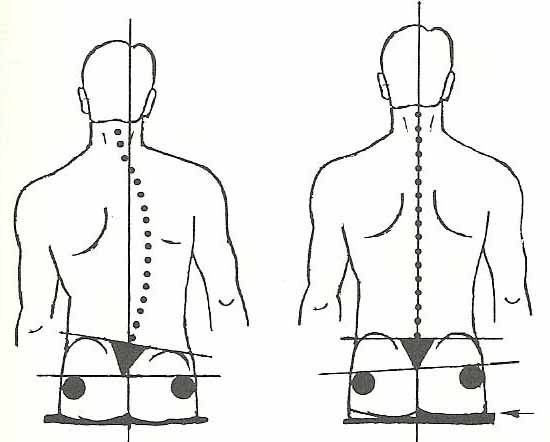 Scoliosis_Fig_48